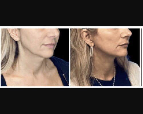 Deep Plane Facelift Before & After Gallery - Patient 427571 - Image 1