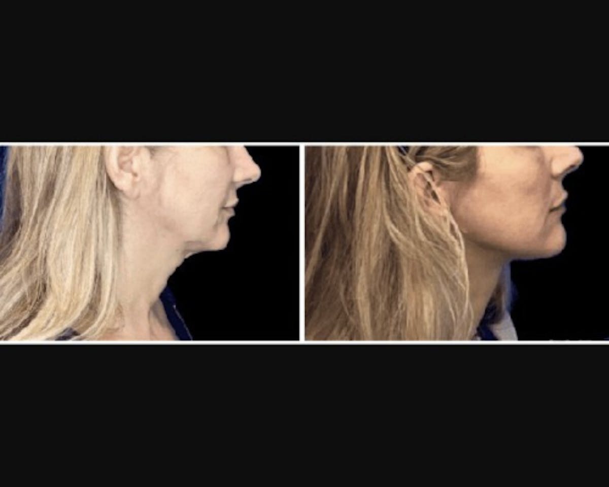 Deep Plane Facelift Before & After Gallery - Patient 427571 - Image 2