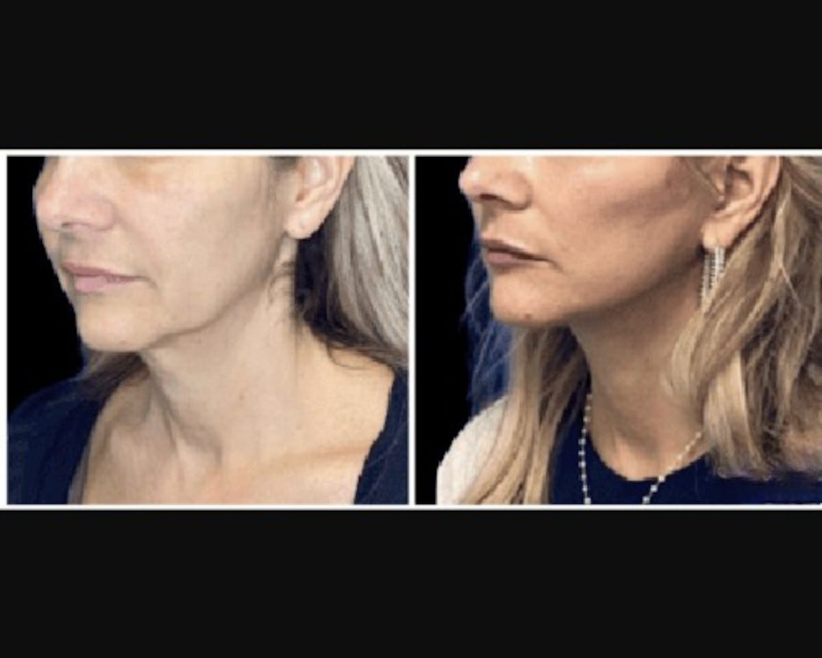 Deep Plane Facelift Before & After Gallery - Patient 427571 - Image 3