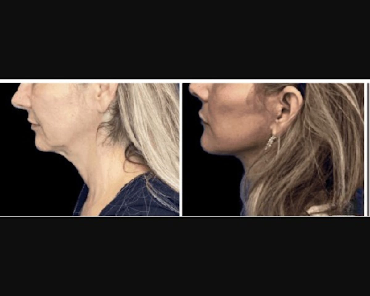 Deep Plane Facelift Before & After Gallery - Patient 427571 - Image 4