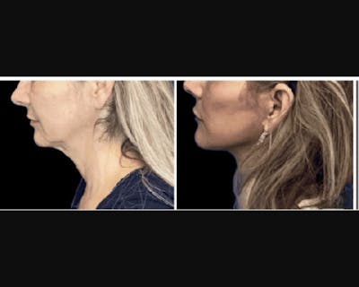Deep Plane Facelift Before & After Gallery - Patient 427571 - Image 4