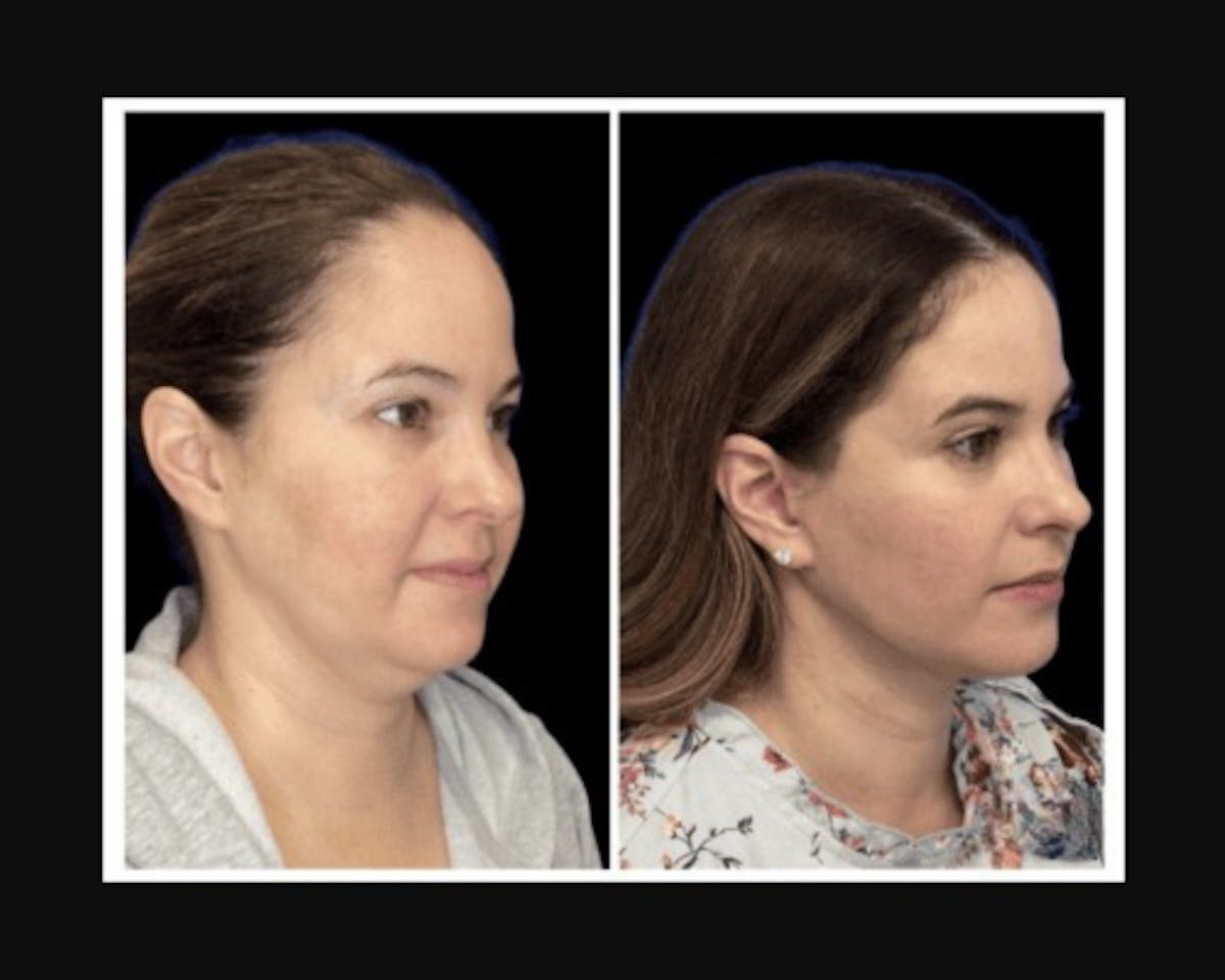 Deep Plane Facelift Before & After Gallery - Patient 115419 - Image 1