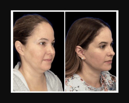 Deep Plane Facelift Before & After Gallery - Patient 115419 - Image 1