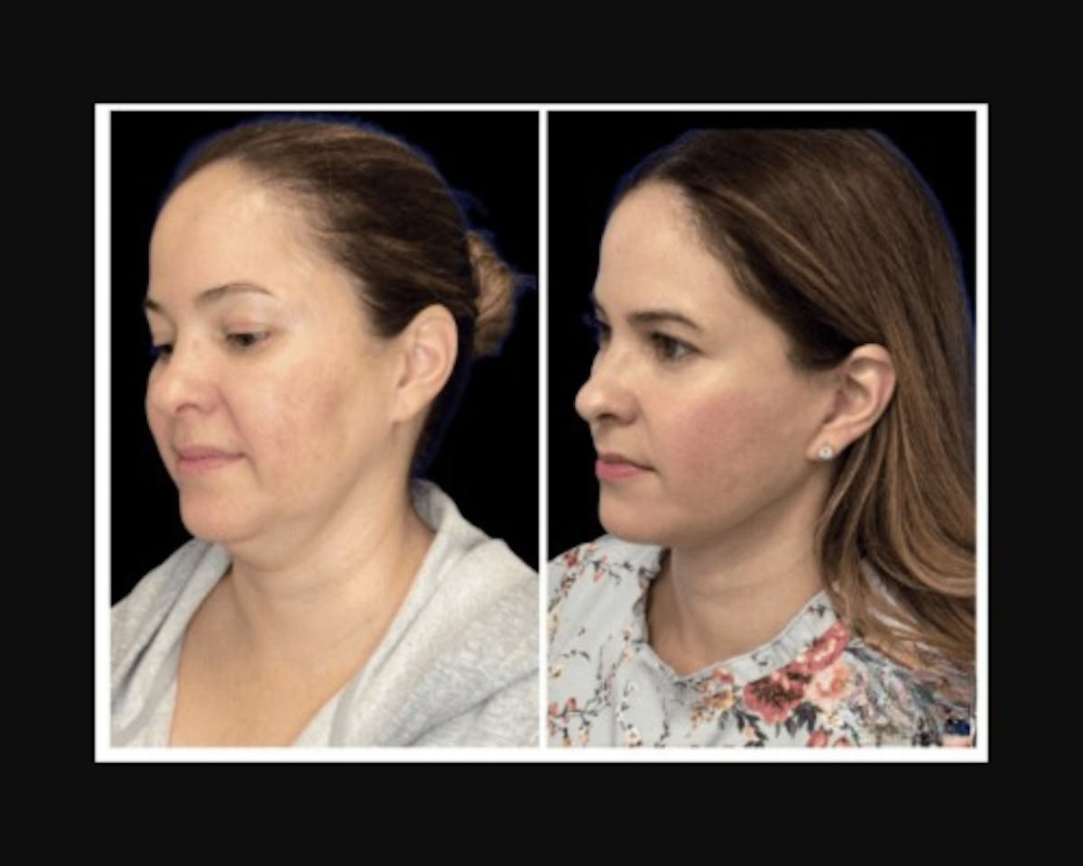 Deep Plane Facelift Before & After Gallery - Patient 115419 - Image 2