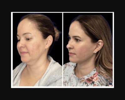 Deep Plane Facelift Before & After Gallery - Patient 115419 - Image 2