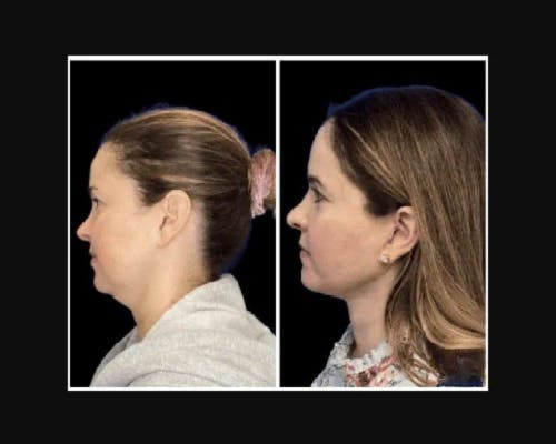 Deep Plane Facelift Before & After Gallery - Patient 115419 - Image 3