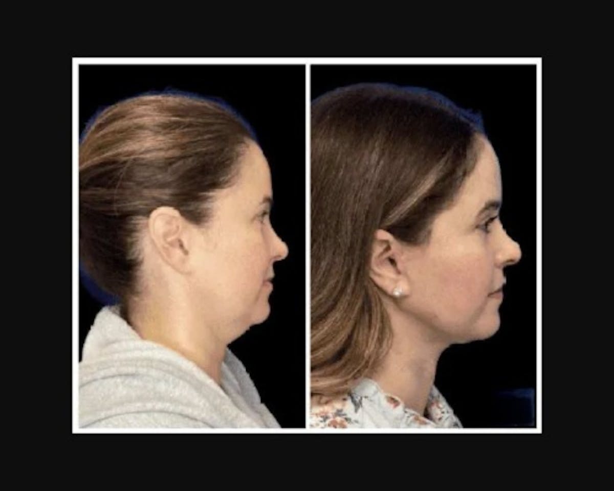 Deep Plane Facelift Before & After Gallery - Patient 115419 - Image 4