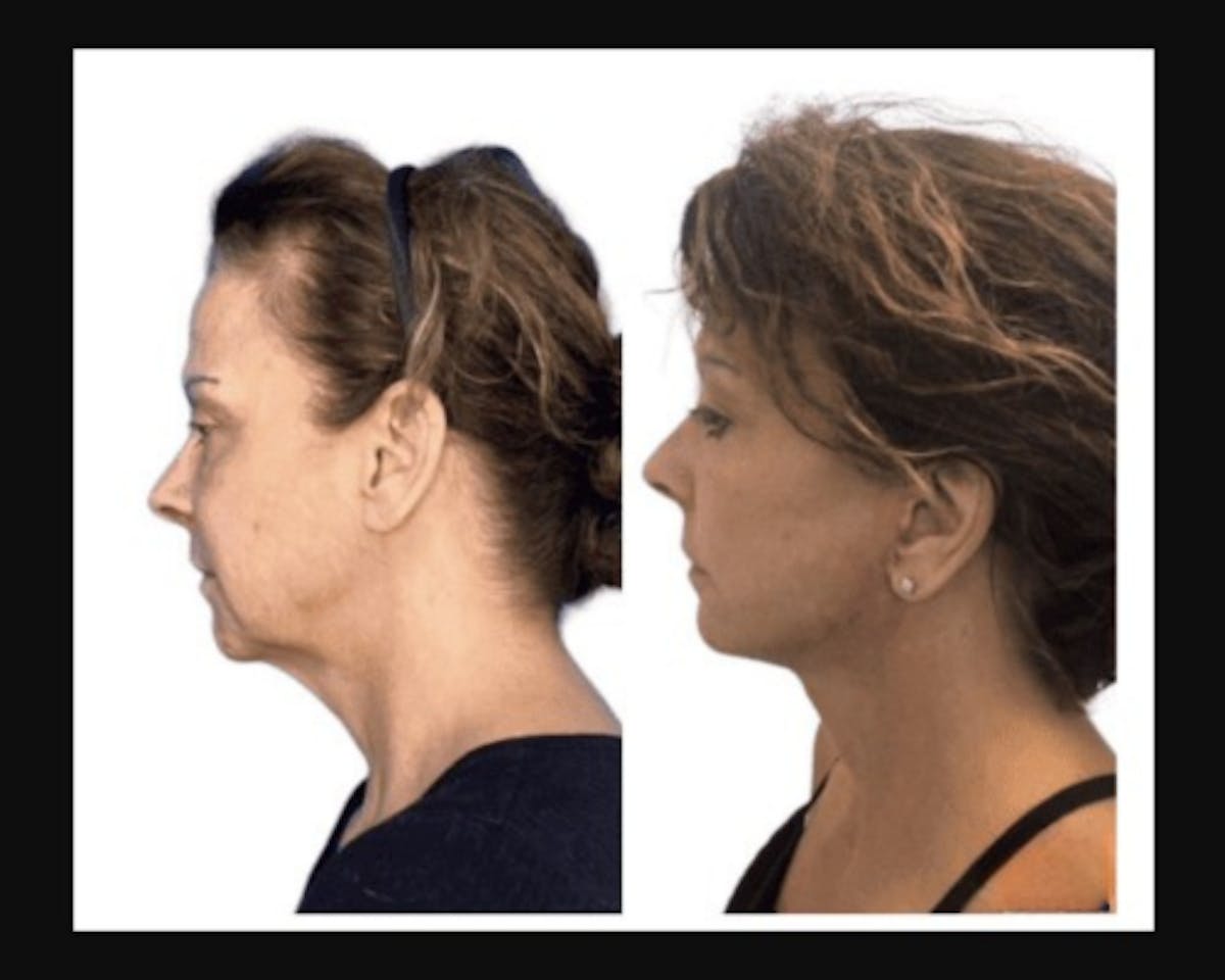 Deep Plane Facelift Before & After Gallery - Patient 874137 - Image 2