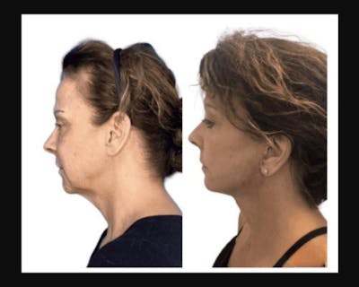 Deep Plane Facelift Before & After Gallery - Patient 874137 - Image 2