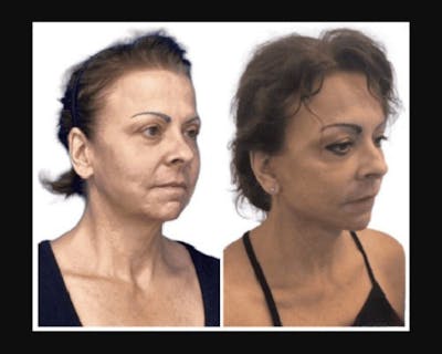 Deep Plane Facelift Before & After Gallery - Patient 874137 - Image 5