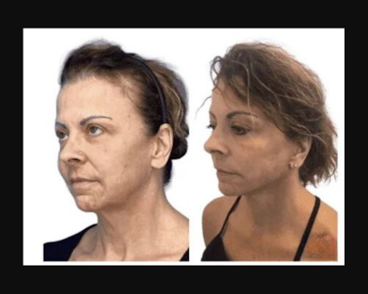 Deep Plane Facelift Before & After Gallery - Patient 874137 - Image 4