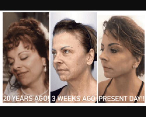 Deep Plane Facelift Before & After Gallery - Patient 874137 - Image 1