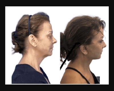 Deep Plane Facelift Before & After Gallery - Patient 874137 - Image 3