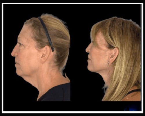 Deep Plane Facelift Before & After Gallery - Patient 138212 - Image 1