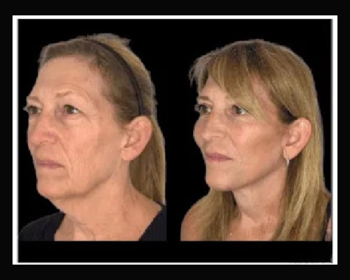 Deep Plane Facelift Before & After Gallery - Patient 138212 - Image 2