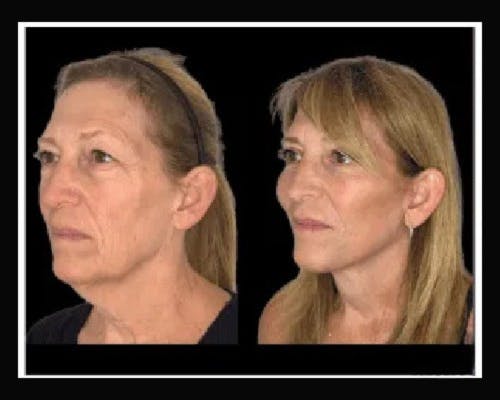 Deep Plane Facelift Before & After Gallery - Patient 138212 - Image 2