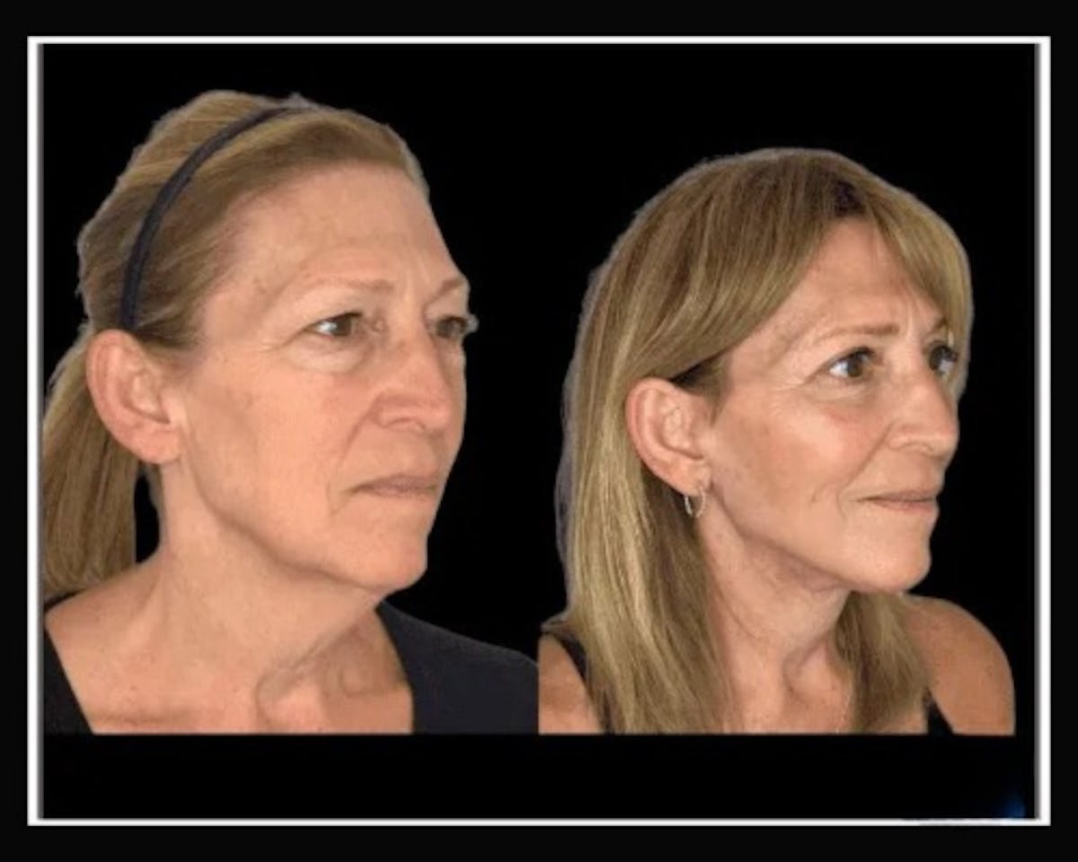 Deep Plane Facelift Before & After Gallery - Patient 138212 - Image 3