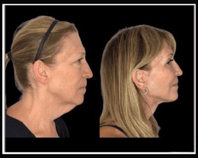 Deep Plane Facelift Before & After Gallery - Patient 138212 - Image 5