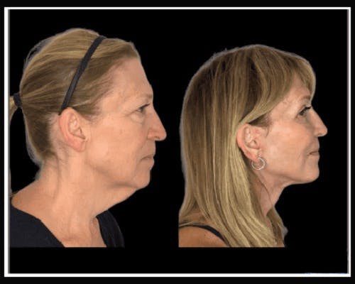 Deep Plane Facelift Before & After Gallery - Patient 138212 - Image 5