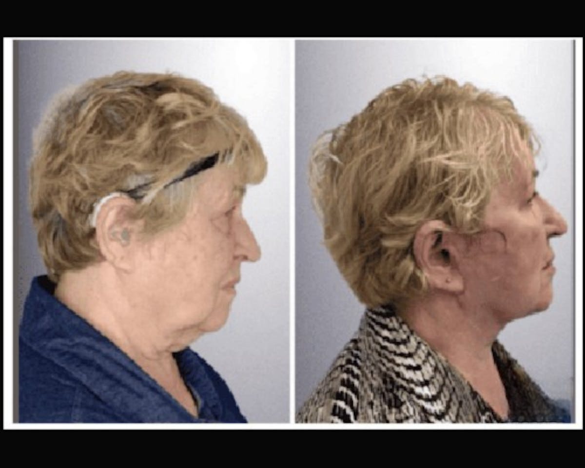 Deep Plane Facelift Before & After Gallery - Patient 426543 - Image 1