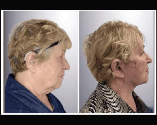 Deep Plane Facelift Before & After Gallery - Patient 426543 - Image 1