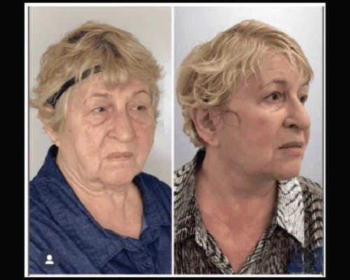Deep Plane Facelift Before & After Gallery - Patient 426543 - Image 2