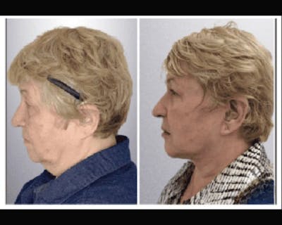 Deep Plane Facelift Before & After Gallery - Patient 426543 - Image 3