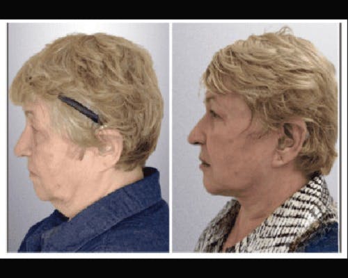 Deep Plane Facelift Before & After Gallery - Patient 426543 - Image 3