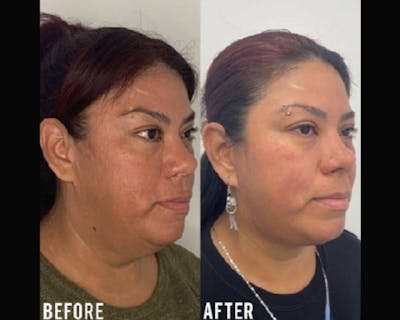 Deep Plane Facelift Before & After Gallery - Patient 307726 - Image 1