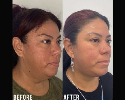 Deep Plane Facelift Before & After Gallery - Patient 307726 - Image 1