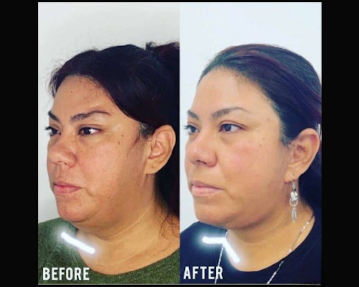 Deep Plane Facelift Before & After Gallery - Patient 307726 - Image 2