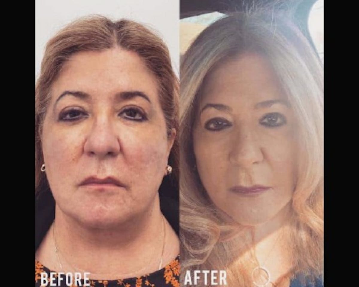 Deep Plane Facelift Before & After Gallery - Patient 405400 - Image 1