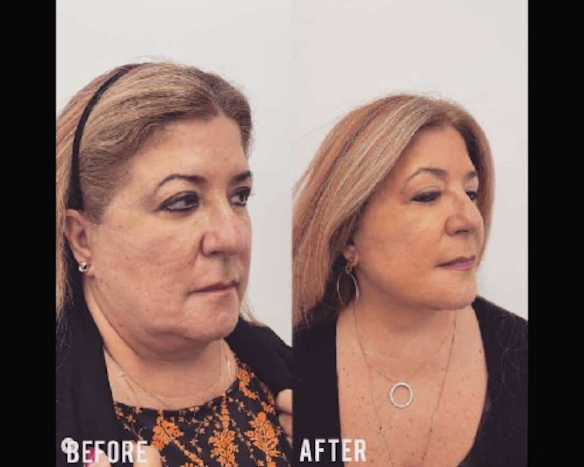 Deep Plane Facelift Before & After Gallery - Patient 405400 - Image 2