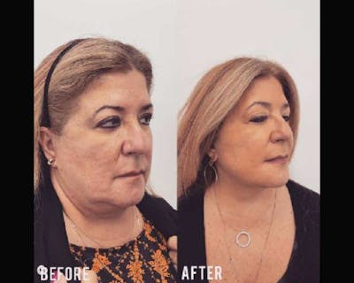 Deep Plane Facelift Before & After Gallery - Patient 405400 - Image 2