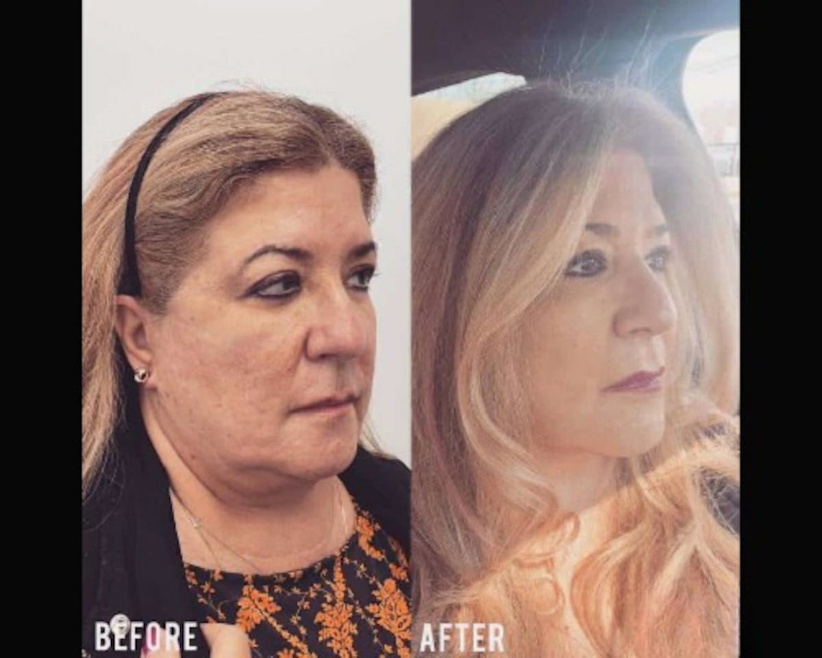 Deep Plane Facelift Before & After Gallery - Patient 405400 - Image 3