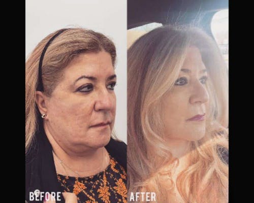 Deep Plane Facelift Before & After Gallery - Patient 405400 - Image 3