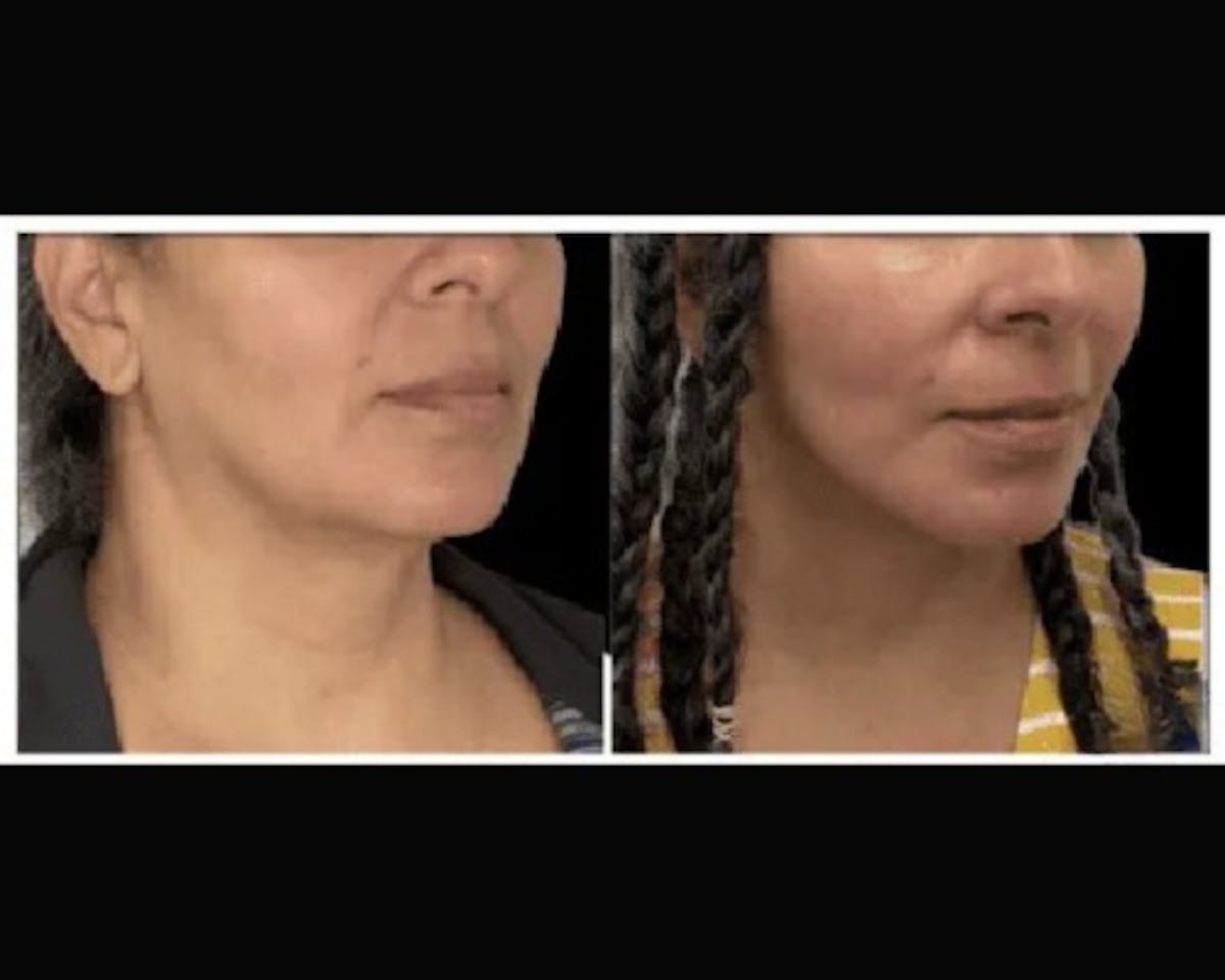 Deep Plane Facelift Before & After Gallery - Patient 428006 - Image 1