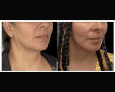 Deep Plane Facelift Before & After Gallery - Patient 428006 - Image 1
