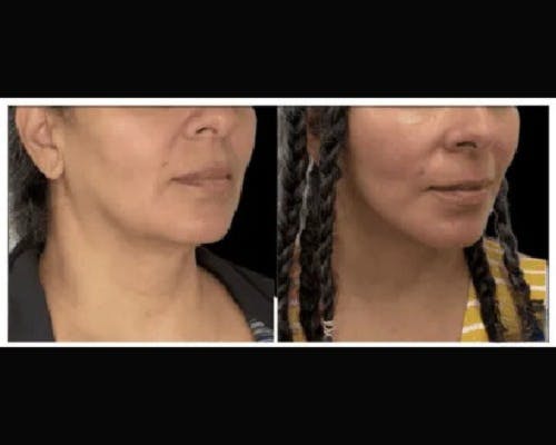 Deep Plane Facelift Before & After Gallery - Patient 428006 - Image 1