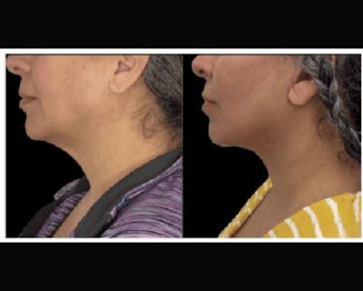 Deep Plane Facelift Before & After Gallery - Patient 428006 - Image 2