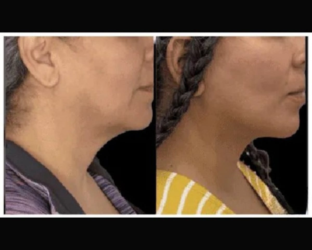 Deep Plane Facelift Before & After Gallery - Patient 428006 - Image 3