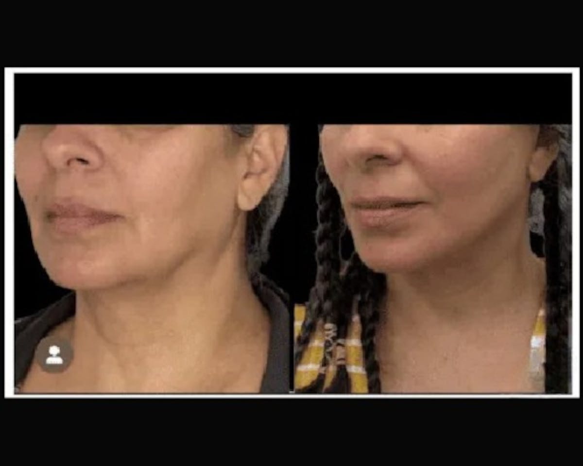 Deep Plane Facelift Before & After Gallery - Patient 428006 - Image 4