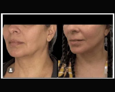 Deep Plane Facelift Before & After Gallery - Patient 428006 - Image 4