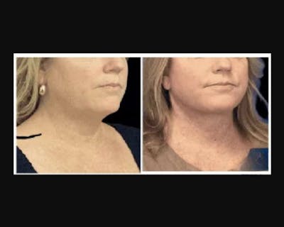 Deep Plane Facelift Before & After Gallery - Patient 268863 - Image 1