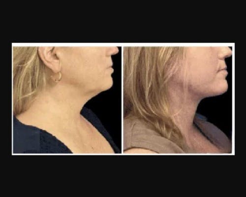 Deep Plane Facelift Before & After Gallery - Patient 268863 - Image 2