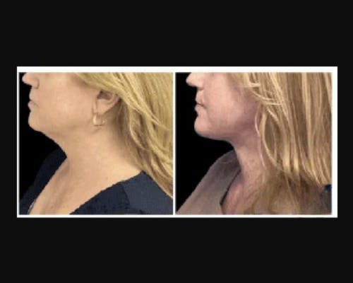 Deep Plane Facelift Before & After Gallery - Patient 268863 - Image 3