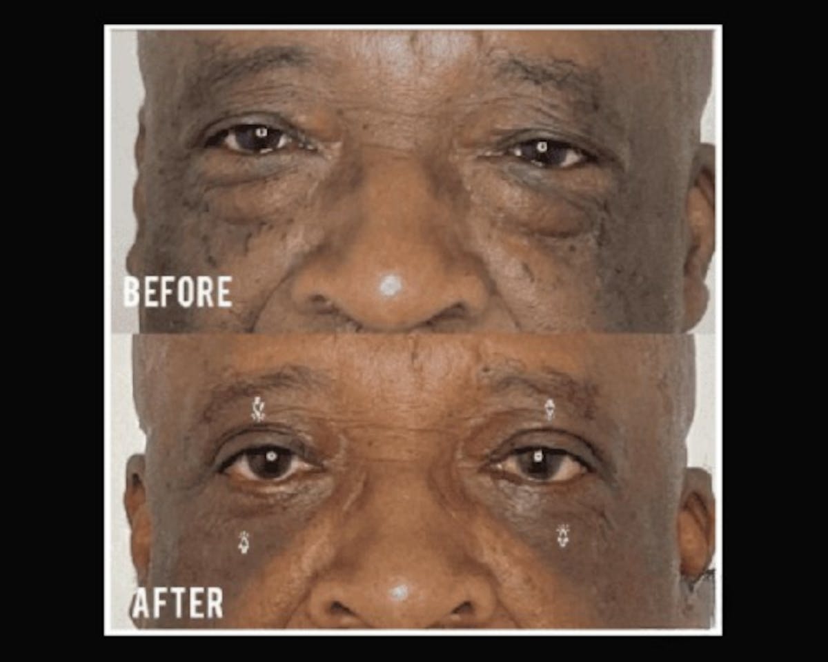  Upper Blepharoplasty Before & After Gallery - Patient 342230 - Image 1