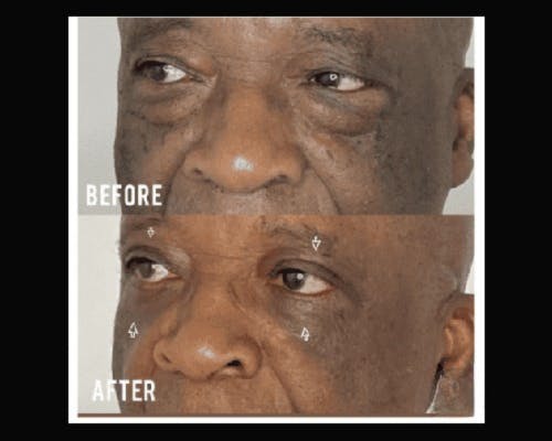 Lower Blepharoplasty Before & After Gallery - Patient 329418 - Image 2