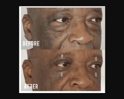 Lower Blepharoplasty Before & After Gallery - Patient 329418 - Image 1