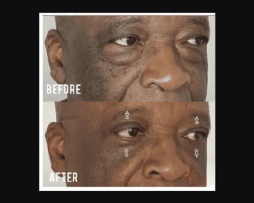 Lower Blepharoplasty Before & After Gallery - Patient 329418 - Image 1